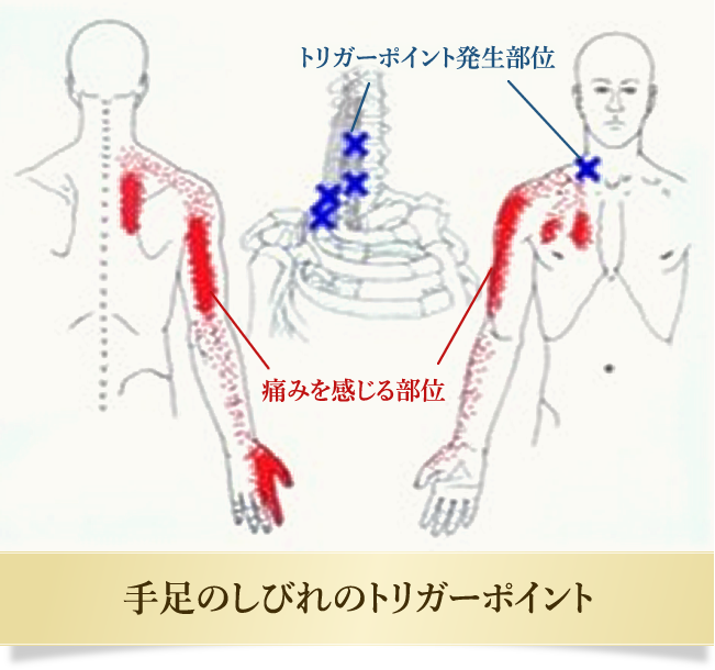 手足のしびれのトリガーポイント